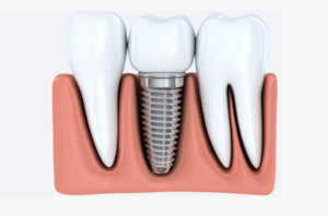 Імплантація зубів – що треба знати